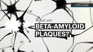 What Are Beta-Amyloids Plaques?
