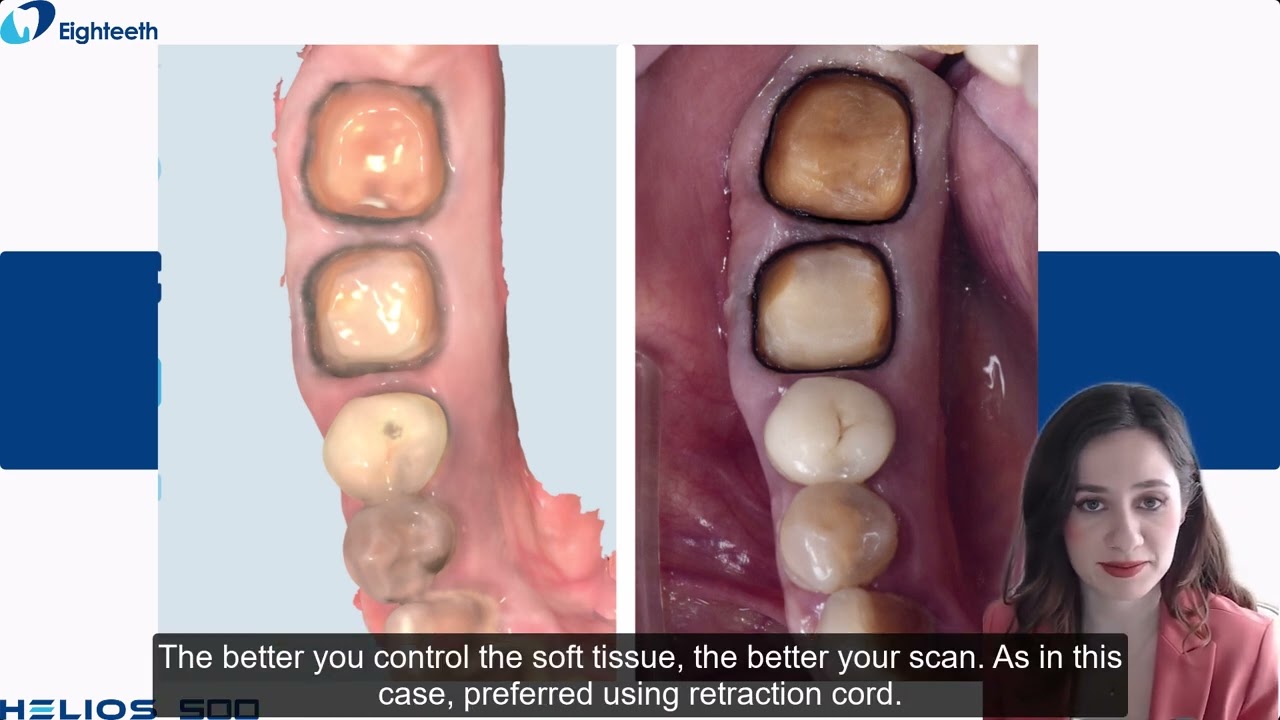6  Helios 500 Restoration Workflow in Exocad