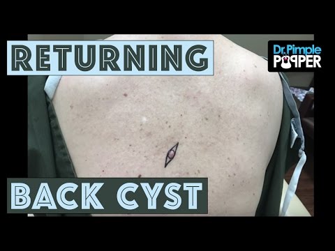 A Re-excision Of A Cyst On The Back