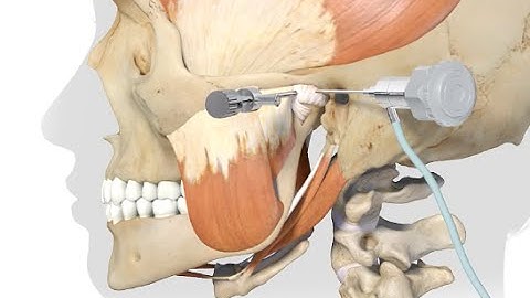 Arthroscopy