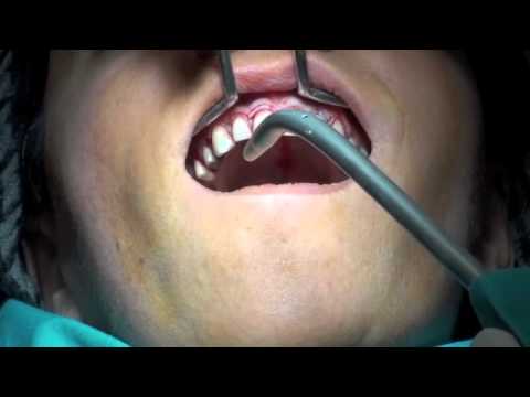 periodontal flap operasyonu