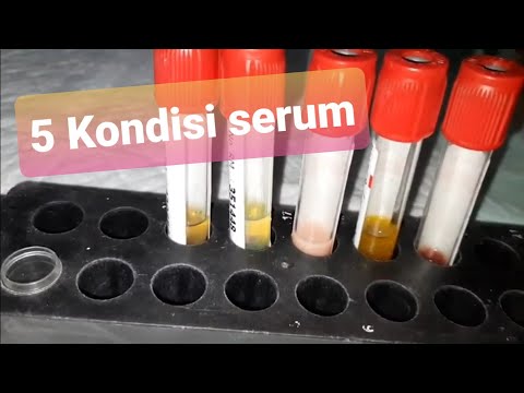 Ikterik | Iipemik | Hemolisis Serum