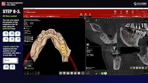 [EN] R2GATE Stand Alone update: Step. 8-3 Direct Implant Control in 3D View