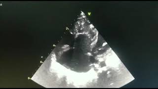 Ebstein in Newborn
