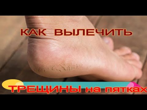 ☝📌КАК ВЫЛЕЧИТЬ ТРЕЩИНЫ НА ПЯТКЕ. ПРОСТОЕ ЭФФЕКТИВНОЕ СРЕДСТВО. ВСЕГО ДВА ИНГРЕДИЕНТА