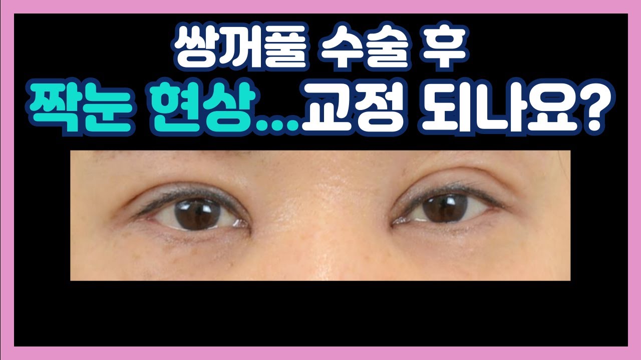 (쌍수 짝짝이 교정) 수술 후 양쪽 눈이 다르게 보이는 이유는?