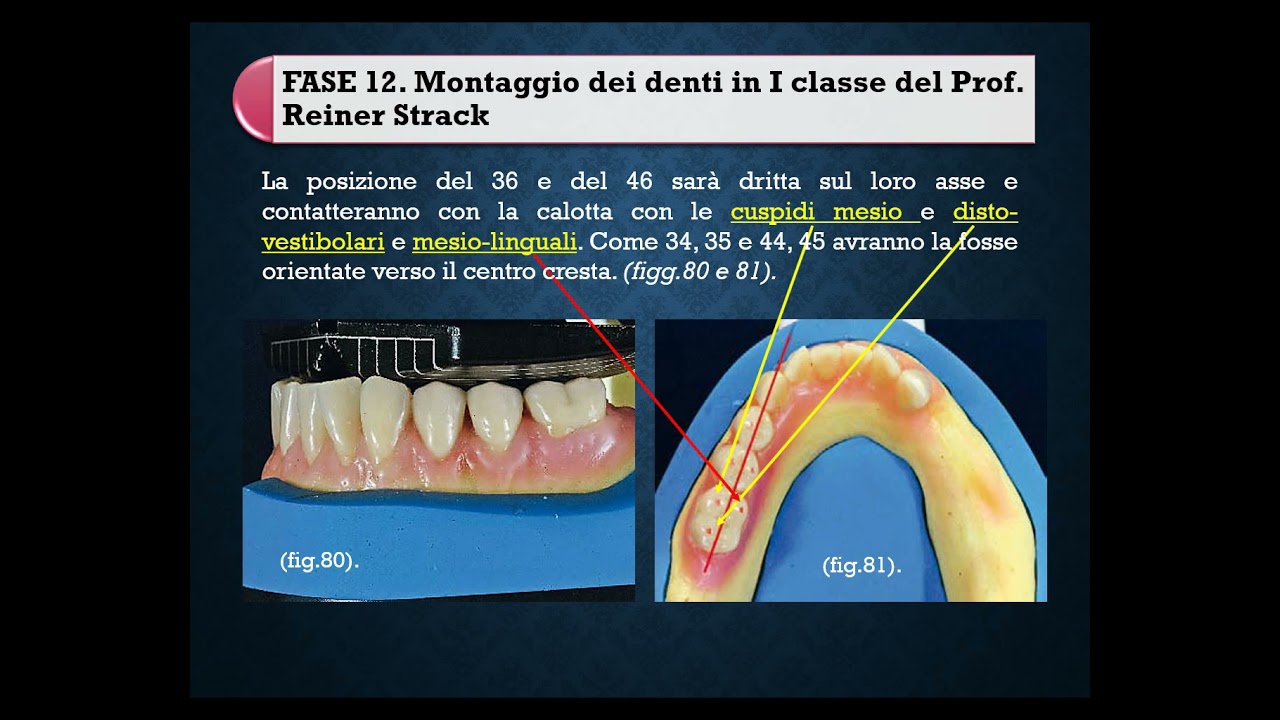 10  IL MONTAGGIO DEI DENTI IN I°CL  DI STRACK E GYSI