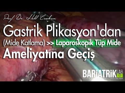 Laparoskopik Mide Katlama Ameliyatından Tüp Mide - Mide Küçültme Ameliyatına Geçiş