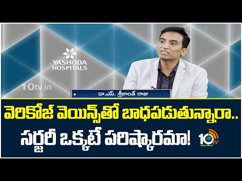 Ayushman Bhava | వెరికోజ్ వెయిన్స్‎తో బాధపడుతున్నారా..సర్జరీ ఒక్కటే పరిష్కారమా! | Yashoda Hospitals - 10TVNEWSTELUGU