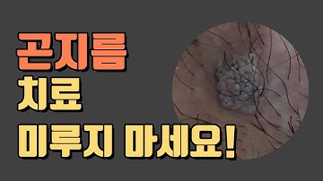 곤지름(condyloma 콘딜로마) = 성기사마귀 치료 미루지 마세요!