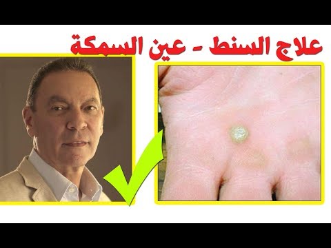 دكتور هانى الناظر العلاج الصحيح لمرض السنطة أو عين السمكة رشتة