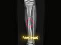What does a broken bone look like before and after healing?#youtubeshorts #science #xray #bones
