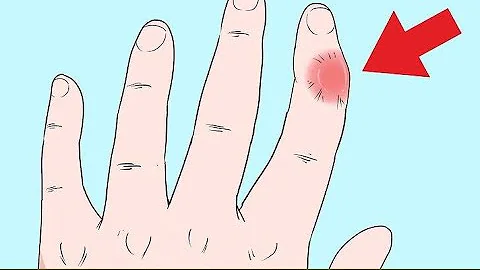 ¿Qué hacen los médicos para un dedo atascado?
