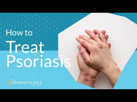 वीडियो: गंभीर पट्टिका सोरायसिस का इलाज कैसे करें: 9 कदम (चित्रों के साथ)