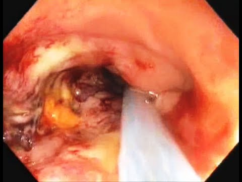 Carcinoma gall bladder with gastric outlet obstruction - Duodenal wall stent placement in - YouTube
