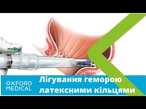 Як лікувати ГЕМОРОЙ без ОПЕРАЦІЇ? ЛІГУВАННЯ латексними кільцями