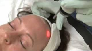 Active FX Fractional CO2 Laser Resurfacing - Part I | Austin Dermatologist