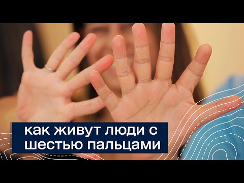 Как живут люди с шестью пальцами. Люди мутанты