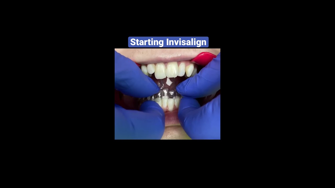 Adult Invisalign