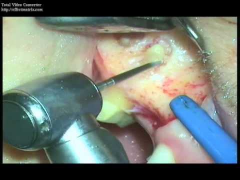 Video: Granuloma Polmonare