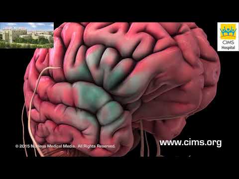 Carotid Endarterectomy  (Hindi) - CIMS Hospital