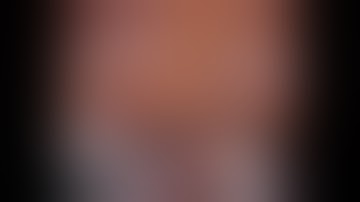 Fissureless Robotic Right Middle Lobectomy with step-by-step narration