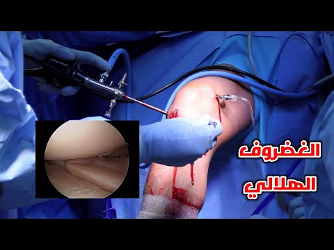 شاهد عملية اصلاح الغضروف الهلالي