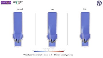 Heart Valve FSI Simulation using Smoothed Particle Hydrodynamics (SPH)
