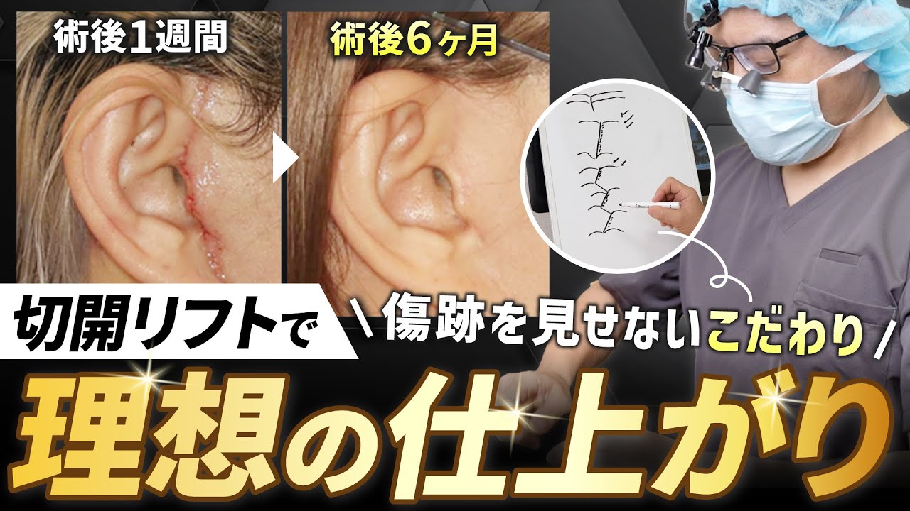 【9割が知らない！？】このひと手間が本当に大事。切開リフトで傷跡を綺麗に見せるためにコレだけは気をつけてください