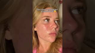 This ONE ingredient fixed my skin when NOTHING else worked !🤯 Profile
