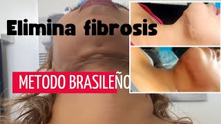 elimina fibrosis despues de una  LIPOPAPADA metodo brasileño [vida sana] gaviota