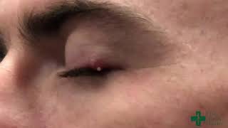 Puncturing a Small Stye or Cyst along the Eyelid Margin