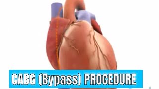 CABG (Coronary artery bypass graft) surgery explained