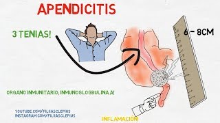 Apendicitis - Cirugía: Signos y síntomas - Escala de Alvarado.