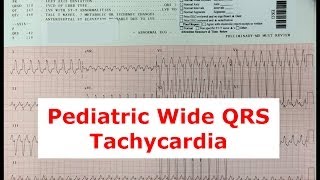 A Pediatric Patient with a Wide QRS Tachycardia