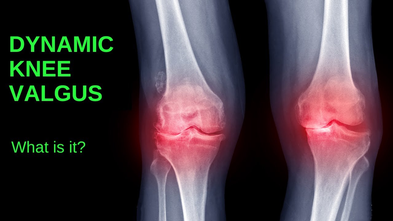 Dynamic Knee Valgus what is it? YouTube