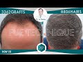 Hair Graft Technique FUE- 3.362 Grafts (8.806 Hairs) - Dr. de Freitas