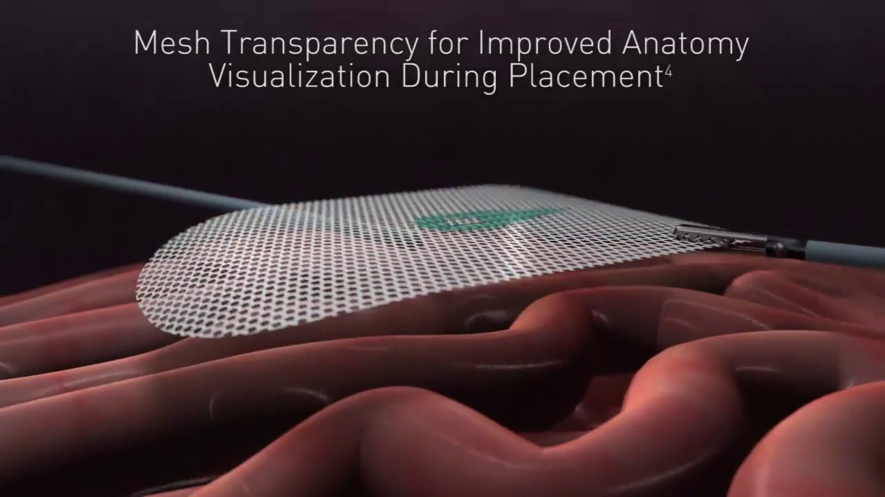 Symbotex™ Composite Mesh For Ventral Hernia Repair Animation Youtube