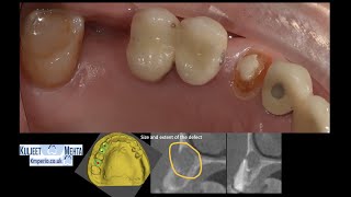 Dental Implant, Socket Shield and GBR by Dr Kuljeet Singh Mehta-Periodontist 4,254 views 1 year ago 23 minutes