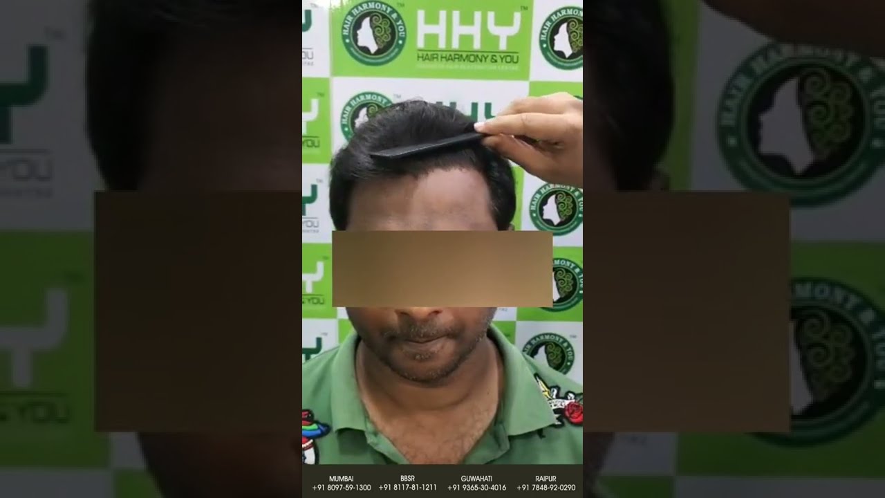 Best Hair transplant Clinic in Guwahati  DrPauls