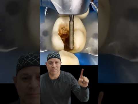 ELIMINACIÓN DE CARIES