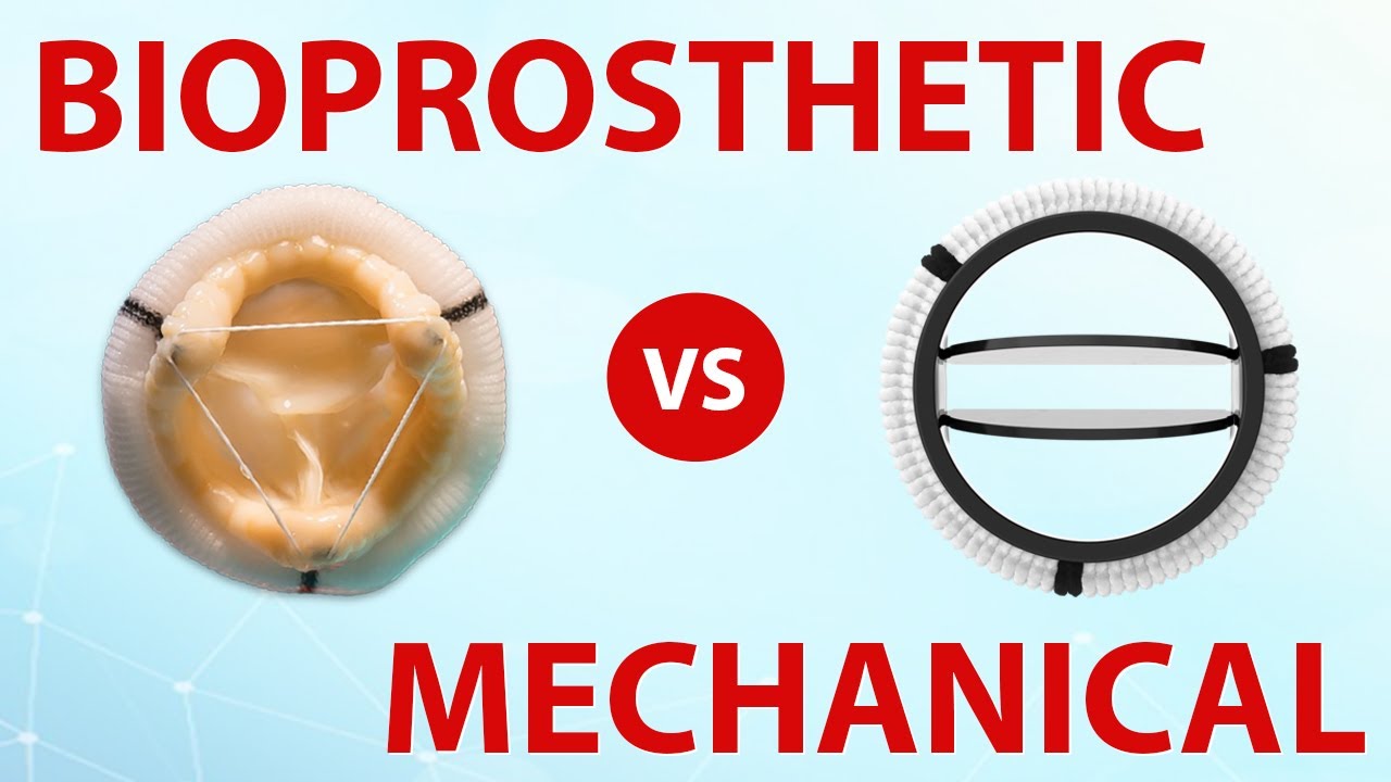 Mechanical or Bioprosthetic Heart Valves Which Is Best For You