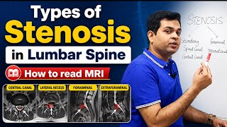 Types of Lumbar Stenosis, Herniated Disc, How to read MRI report of L4-L5 Disc Bulge