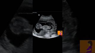 Ultrasound showing Cute Fetusshorts