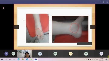 Chẩn đoán viêm cột sống dính khớp: ứng dụng tiêu chuẩn hình ảnh học | ThS. BS. Đinh Thị Minh Hảo