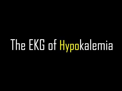 EKG of Hypokalemia กลไกพื้นฐาน การอ่าน การรักษา | The Pacemaker