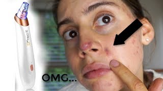 THIS PRODUCT BRUISED MY FACE || My HONEST thoughts on blackhead removers.