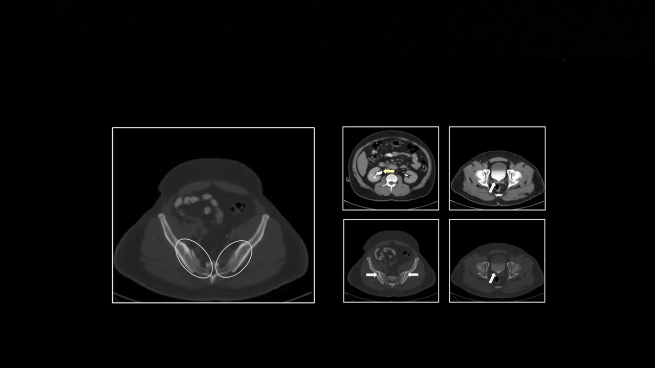 КТ-исследование патологии мочевыводящих путей 1 | Бесплатное повышение квалификации в области рад...
