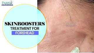 #Skinboosters Treatment for Forehead | Skin Rejuvenation and Hydration using Skin Boosters