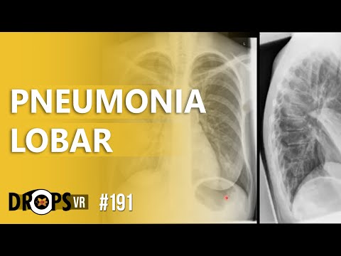 PNEUMONIA LOBAR NO RAIO-X